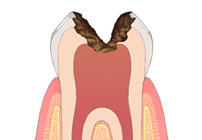 虫歯の治療