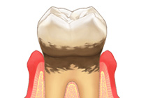 歯周病治療