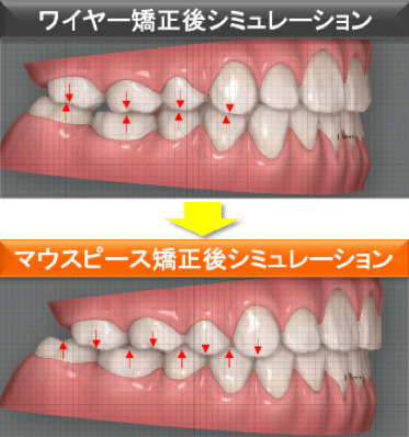 ワイヤー矯正後シミュレーション→マウスピース矯正後シミュレーション